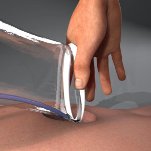 Medical Device Surgery 3D Animation