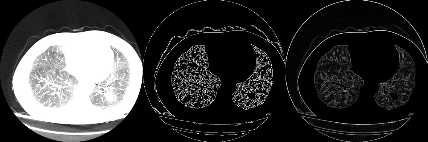 Medical Image Processing Leukemia  