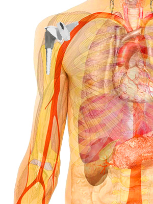 Human Body Shoulder Implant
